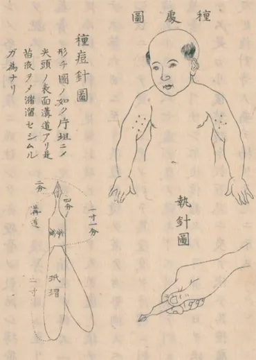 天然痘との戦い/予防接種のはじまり